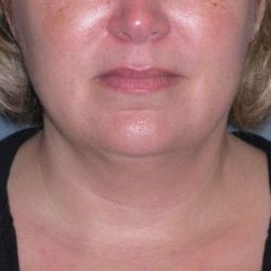 Deep Plane Lower Face & Neck Lift Before & After Patient #947
