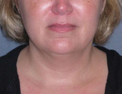 Deep Plane Lower Face & Neck Lift Before & After Patient #947