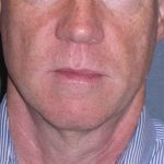 Deep Plane Mini Lift & Neck Lift Before & After Patient #965