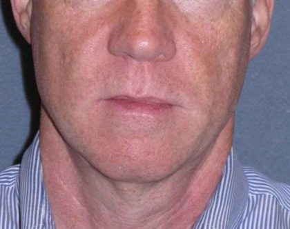 Deep Plane Mini Lift & Neck Lift Before & After Patient #965