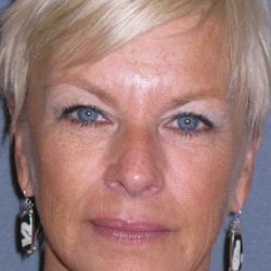 Deep Plane Mini Lift & Neck Lift Before & After Patient #972