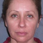 Deep Plane Mini Lift & Neck Lift Before & After Patient #981