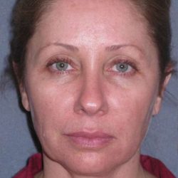 Deep Plane Mini Lift & Neck Lift Before & After Patient #981
