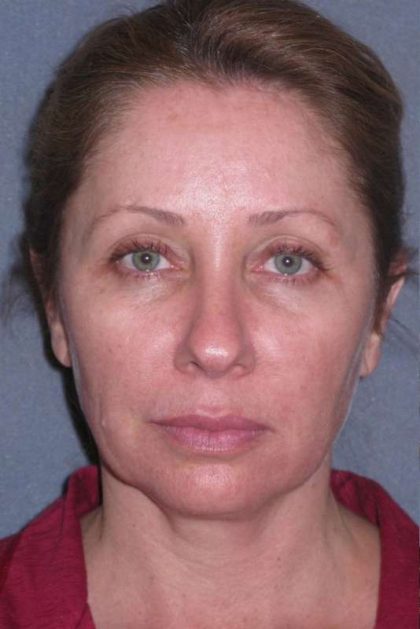 Deep Plane Mini Lift & Neck Lift Before & After Patient #981
