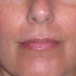 Juv&eacute;derm - Lips Before & After Patient #662