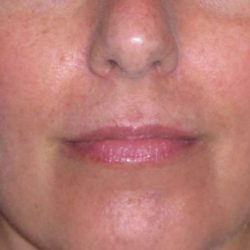 Juvéderm - Lips Before & After Patient #662