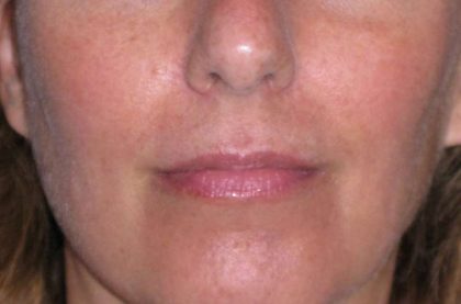 Juvéderm - Lips Before & After Patient #662