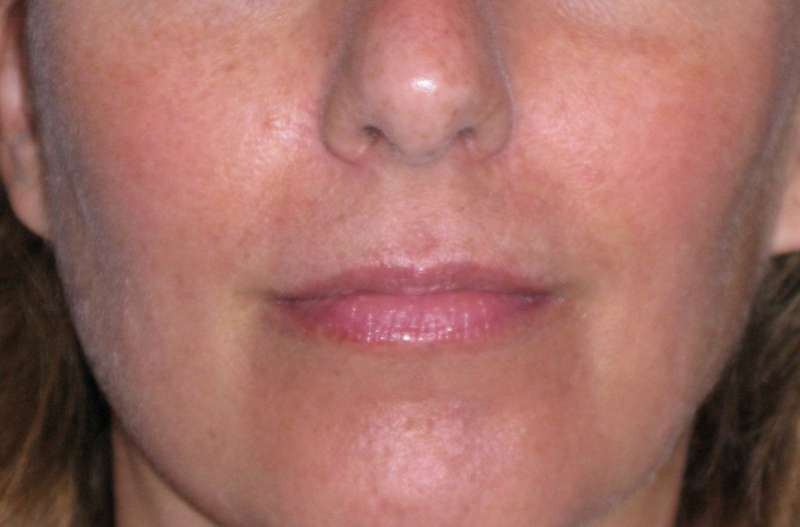 Juv&eacute;derm - Lips Before & After Patient #662