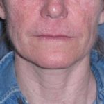 Deep Plane Mini Lift & Neck Lift Before & After Patient #988