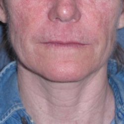 Deep Plane Mini Lift & Neck Lift Before & After Patient #988