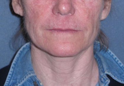 Deep Plane Mini Lift & Neck Lift Before & After Patient #988