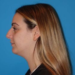Neck Liposuction Before & After Patient #999