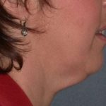 Neck Lift Before & After Patient #1002