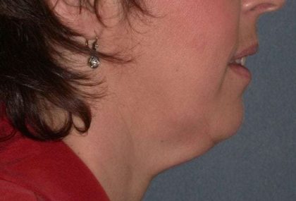 Neck Lift Before & After Patient #1002