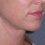 Neck Lift Before & After Patient #1007