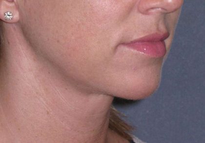 Neck Lift Before & After Patient #1007