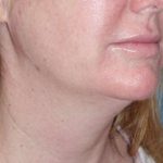 Neck Lift Before & After Patient #1018