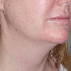 Neck Lift Before & After Patient #1018