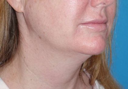 Neck Lift Before & After Patient #1018