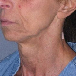 Deep Plane Mini Lift & Neck Lift Before & After Patient #1023