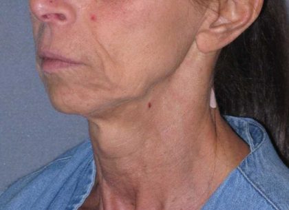 Deep Plane Mini Lift & Neck Lift Before & After Patient #1023