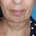 Deep Plane Lower Face & Neck Lift Before & After Patient #1041