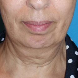 Deep Plane Lower Face & Neck Lift Before & After Patient #1041