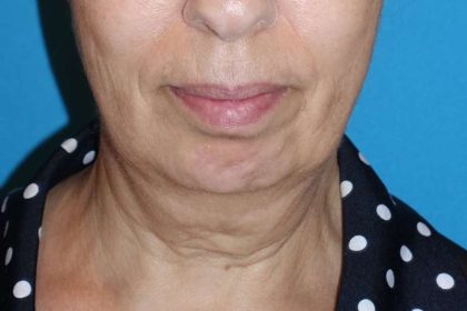 Deep Plane Lower Face & Neck Lift Before & After Patient #1041