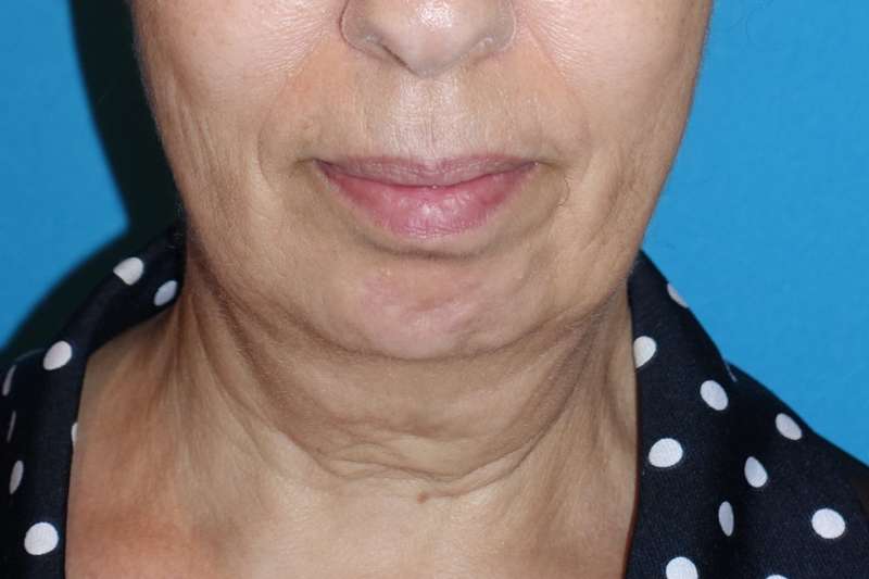 Deep Plane Lower Face & Neck Lift Before & After Patient #1041