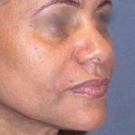 Juv&eacute;derm - Laugh Lines Before & After Patient #665