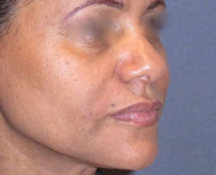 Juvéderm - Laugh Lines Before & After Patient #665