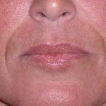 Juv&eacute;derm - Laugh Lines Before & After Patient #670