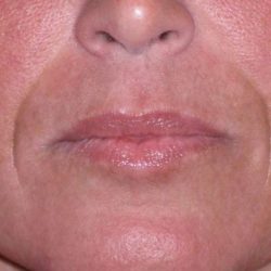 Juvéderm - Laugh Lines Before & After Patient #670