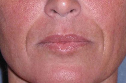 Juvéderm - Laugh Lines Before & After Patient #670