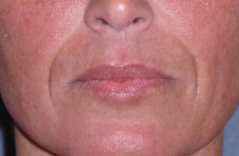 Juvéderm - Laugh Lines Before & After Patient #670