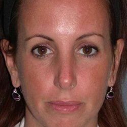 Fraxel Restore Before & After Patient #677