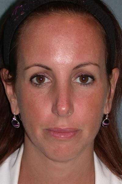 Fraxel Restore Before & After Patient #677