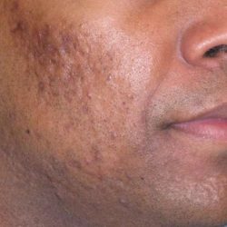 Fraxel Restore Acne Scarring Before & After Patient #682