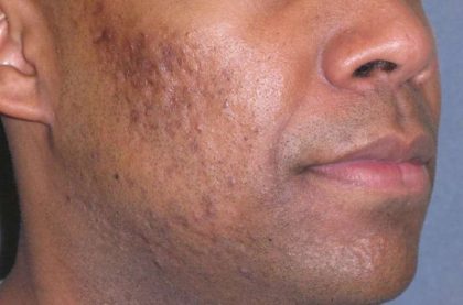 Fraxel Restore Acne Scarring Before & After Patient #682