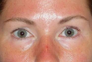 Juvéderm - Tear Troughs Before & After Patient #648
