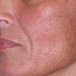Juv&eacute;derm - Laugh Lines Before & After Patient #670