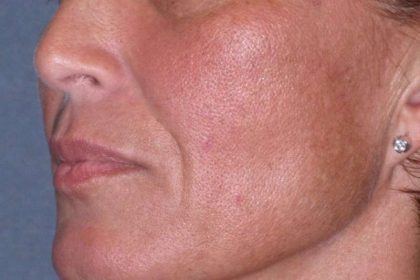 Juvéderm - Laugh Lines Before & After Patient #670