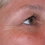 Eyelid Lift- Upper Before & After Patient #747