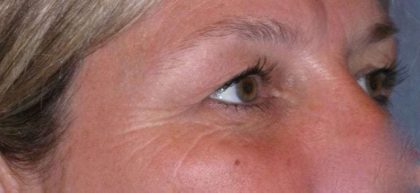 Eyelid Lift- Upper Before & After Patient #747