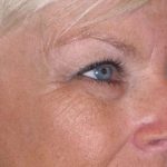 Eyelid Lift- Upper Before & After Patient #754