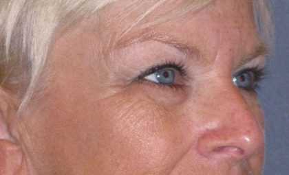 Eyelid Lift- Upper Before & After Patient #754