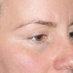 Eyelid Lift- Upper Before & After Patient #765