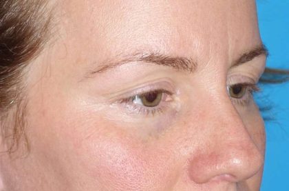 Eyelid Lift- Upper Before & After Patient #765