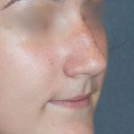 Rhinoplasty Before & After Patient #787