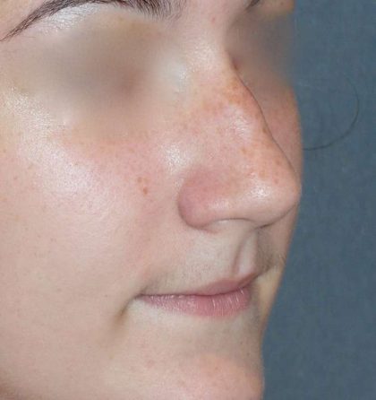 Rhinoplasty Before & After Patient #787